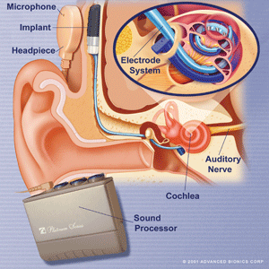 CochlearImplantParts CochlearImplantParts