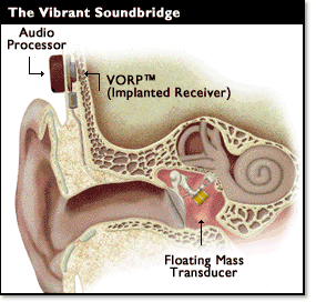 eardr1 eardr1